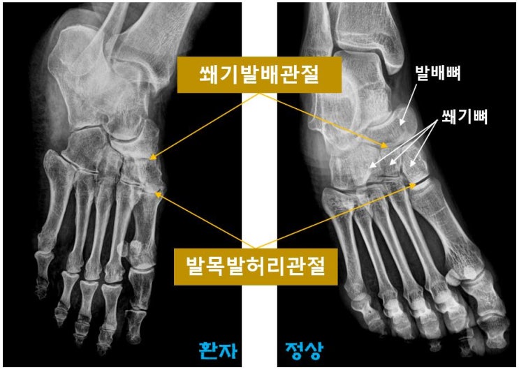  광주 발목 병원 발등 관절 통증이 계속된 이유