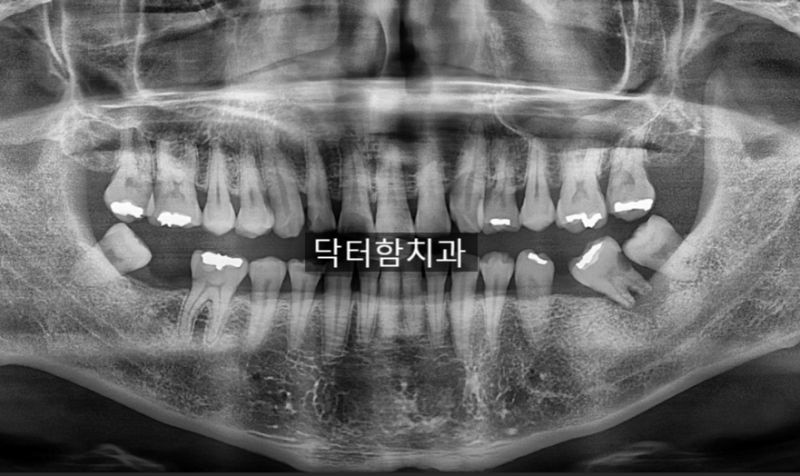 인천석남동치과임플란트는 나이와 관련이 있나요?
