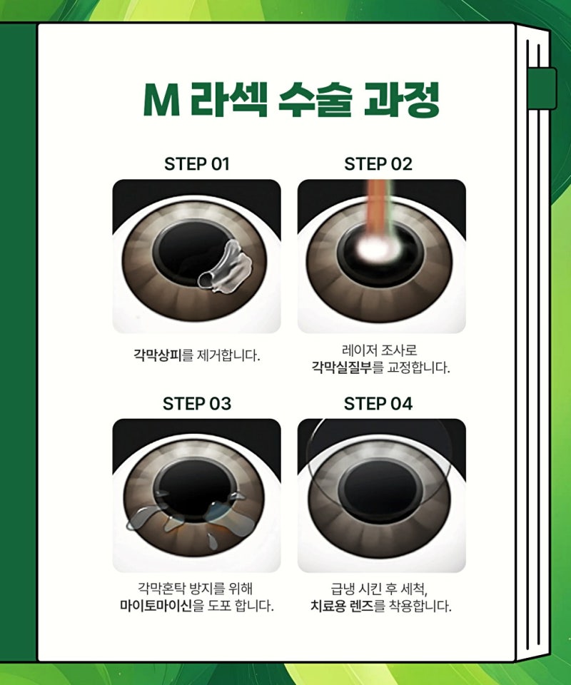 라식수술 비용 확인 후 고려할 점
