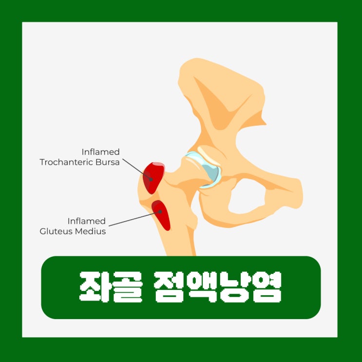  좌골 점액낭염 증상 왼쪽 엉덩이 통증 원인 방석 치료 병원
