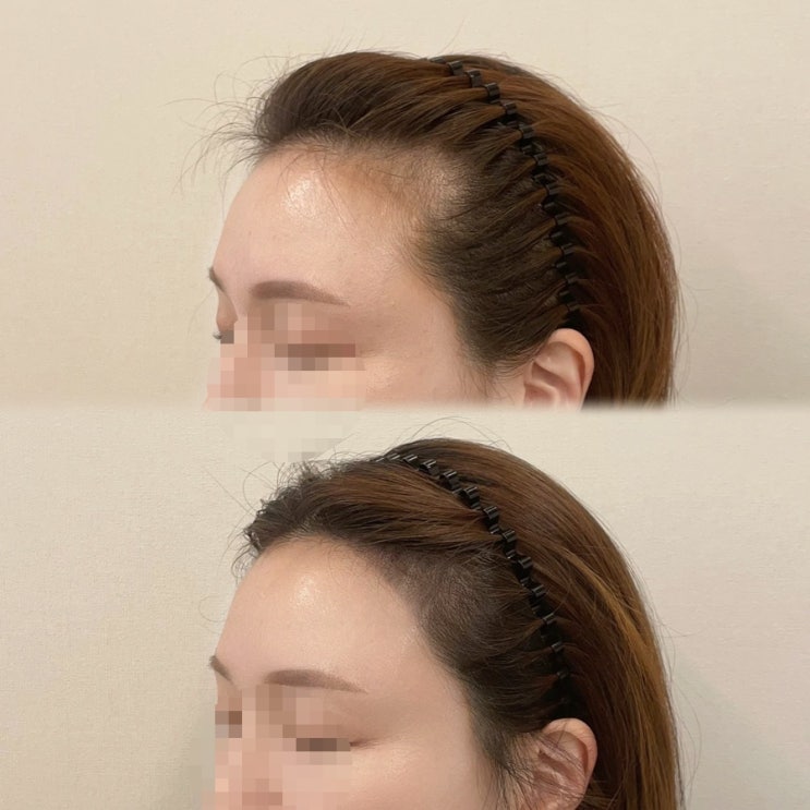  [잠실 헤어라인 반영구] 인앤무드:: 리터치 필요 없는 1회 시술로 예쁜 헤어라인 완성