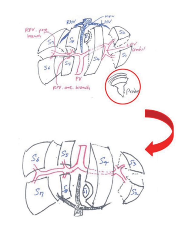 [복부 초음파] 간(Liver) - 1. 엽(lobe)&구역(segment) : 네이버 블로그
