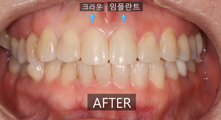  50대 앞니 임플란트 후기(치아 뿌리 파절되어 발치한 사례)
