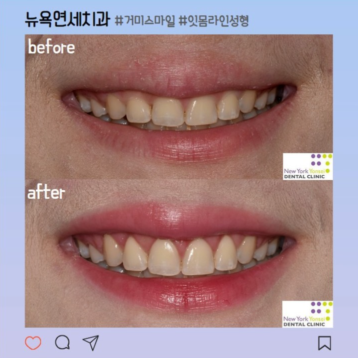  잇몸성형 후기, 비용, 주의사항