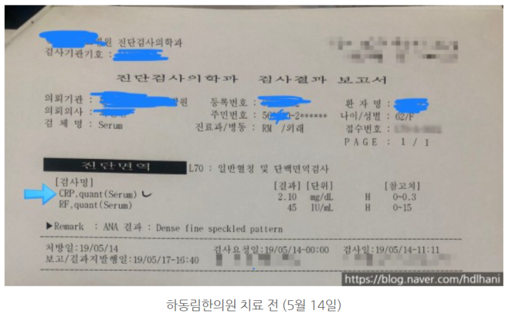  류마티스 관절염, 치료 2주도 안되어 염증 수치 호전된 사례