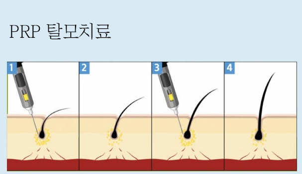 PRP 탈모치료, 줄기세포 탈모치료 의 한계(활성혈소판 치료와 비교)