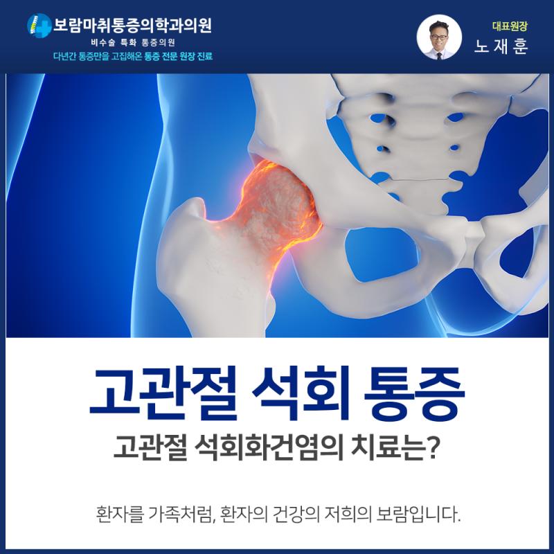 고관절 석회 통증, 고관절 석회화건염의 치료는?