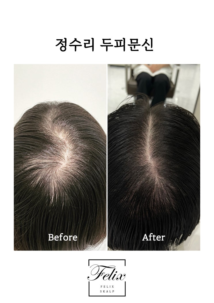  구래동 양곡 양촌 탈모탈출 smp두피문신으로
