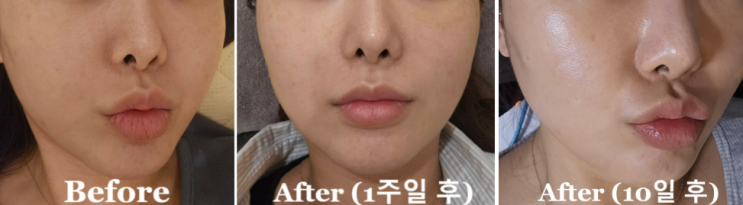  강남역피부과 스킨부스터 꿀조합 리쥬란+물광주사+스킨보톡스 후기