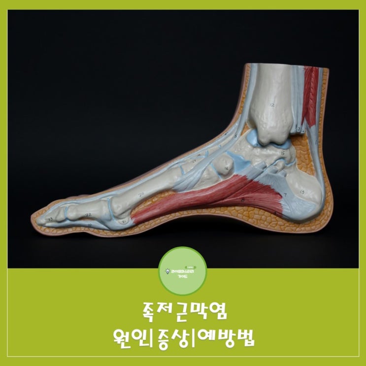  족저근막염 원인|증상|예방법 알아보기