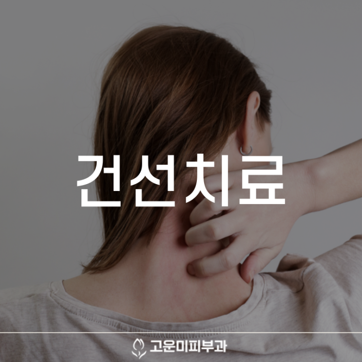  대구반월당건선치료 피부의 상태와 증상에 따른 맞춤 치료와 꾸준한 관리가 중요합니다