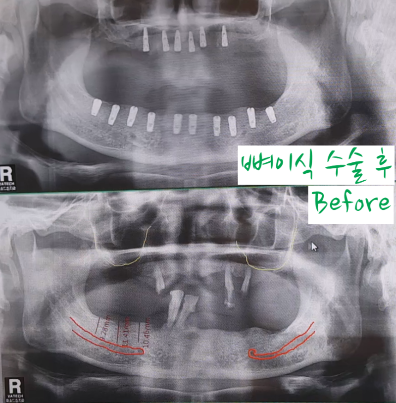 임플란트 뼈이식 후 확인해야 할 조건 2