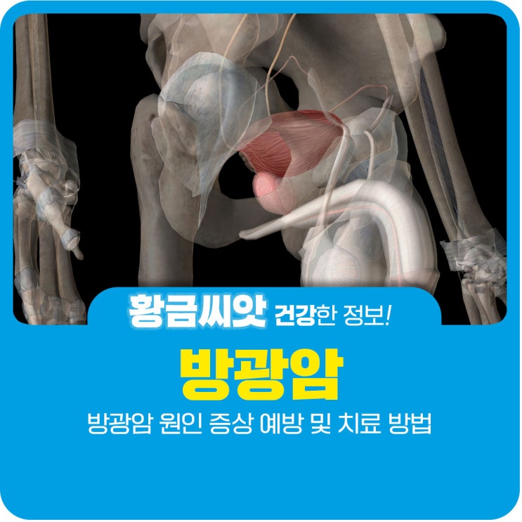  방광암 원인 종류 예방 및 치료 방법