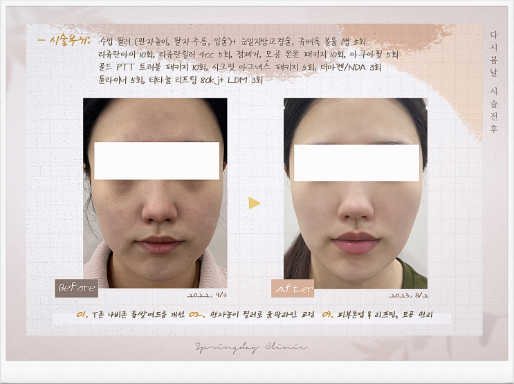  강서구피부과 피코슈어 후기 피부톤 개선