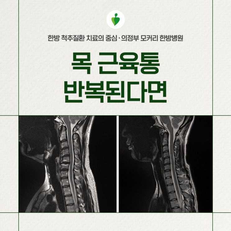  목 근육통이 지속되거나 반복적으로 발생한다면?