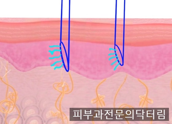  더마샤인(밸런스, 프로) 스킨부스터 주입 기기 - 삼성중앙역 피부과전문의 닥터림