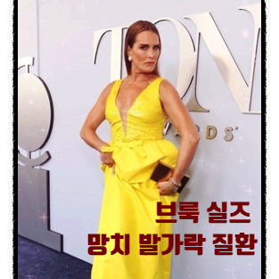  할리우드 배우 브룩 실즈가 노란 크록스를 신고 레드카펫에 간 이유는? 망치 발가락 질환