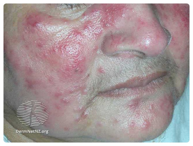  붉은 얼굴이 고민이시면 주사 (Rosacea)를 의심해 보세요