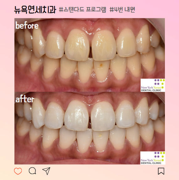  강남역치아미백 잘하는곳 추천 당일 3회 후기