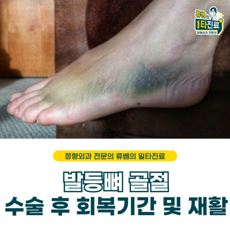  발등뼈 골절 수술/ 수술 후 회복기간, 핀 제거 시기(의사작성)