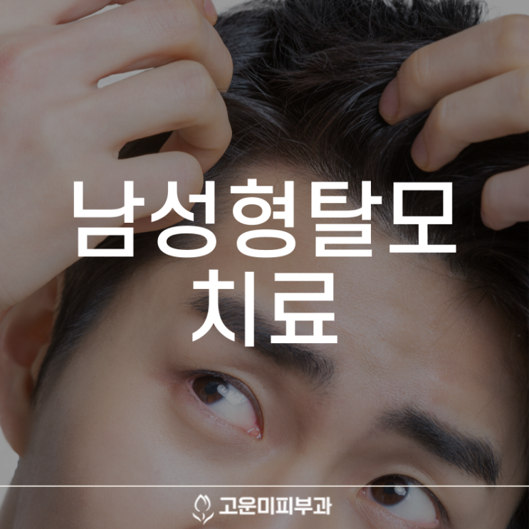  대구반월당탈모치료 남성형 탈모 발병 원인에 따른 조치 치료가 중요합니다