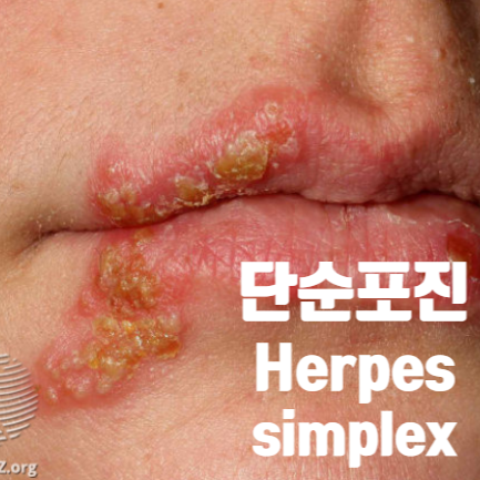 단순포진(Herpes simplex)의 모든 것 (성병? 대상포진과의 차이? 잦은 재발 예방방법?)