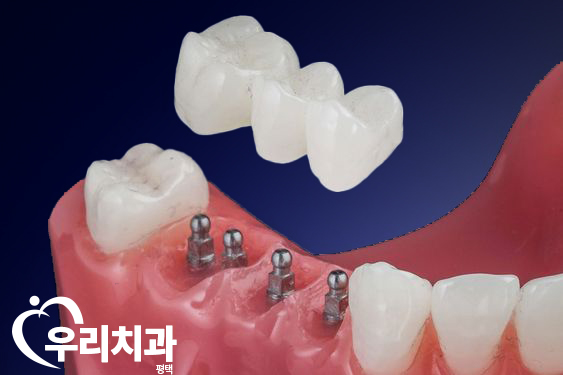  평택역치과 방치 하지 말고 임플란트 하셔야