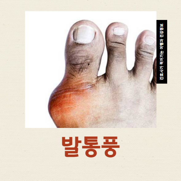 발통풍 초기 증상 엄지발가락 통증 어떻게 관리해야 할까?