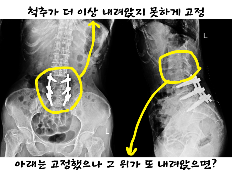  부산척추관협착증, 엄마가 조금만 걸어도 아파하세요. 어떻게 해야 하죠?