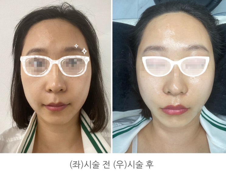  [서울 신사]페이스 잔털관리비비아트 신사본점에서      스킨플래닝시술받고 톤이 한결 밝아졌어요
