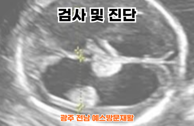 뇌실확장증 (Ventriculomegaly), 뇌실확장, 태아, 신생아, 원인, 증상, 진단, 치료 : 네이버 블로그