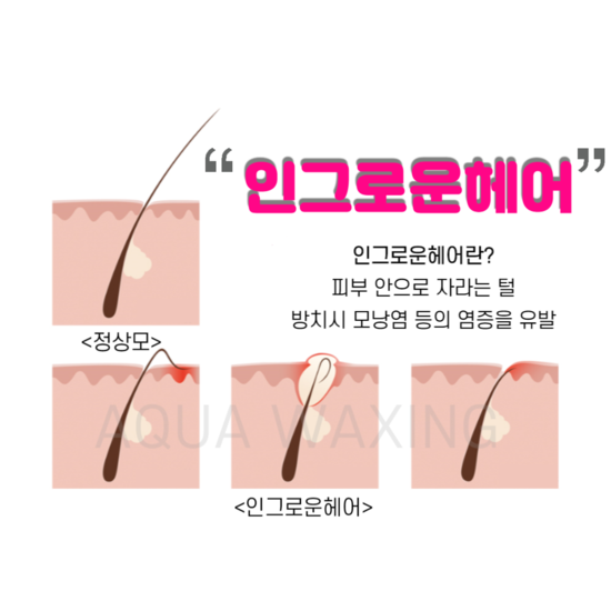  부산 울산 아쿠아왁싱에서 8년차 남자왁서가 알려주는 인그로운 헤어 관리 방법