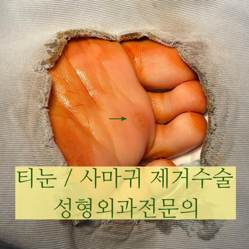 안산 성형외과에서 하는 티눈, 사마귀 제거수술 [건강보험 기준]