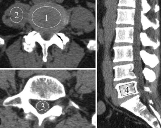 요추 CT xray 요추 엑스레이 검사 하는 이유, 장점과 단점 방법 각 영상 촬영 검사의 주의사항 및 부작용 까지 : 네이버 블로그