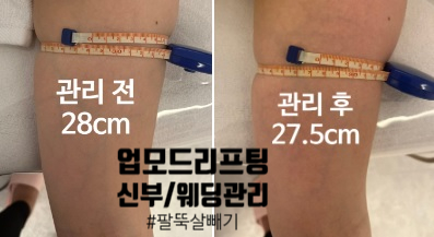  대구 신부관리 달서구 월성동 웨딩관리 팔뚝살빼기 하울뷰티