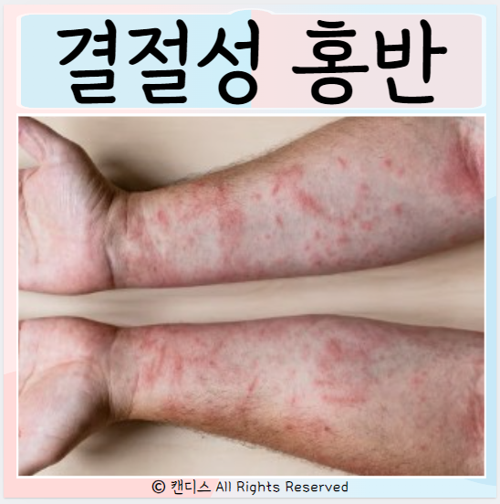  결절성 홍반 원인 진단 치료 증상