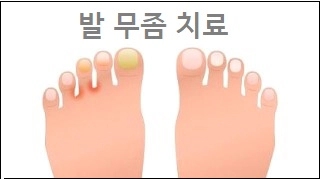  발 무좀 치료 발 무좀 종류