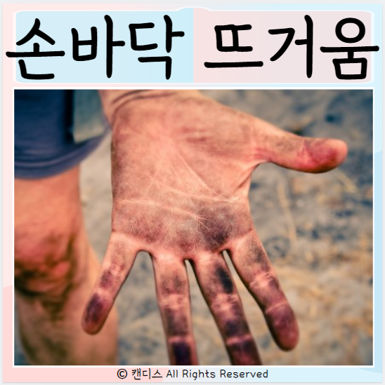  손바닥이 뜨거워요 이유가 뭘까? 원인