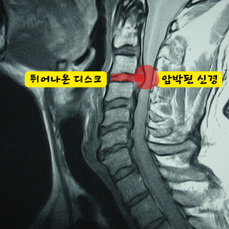  해운대중동정형외과, 목 디스크로 수술까지 가고 싶지 않다면?
