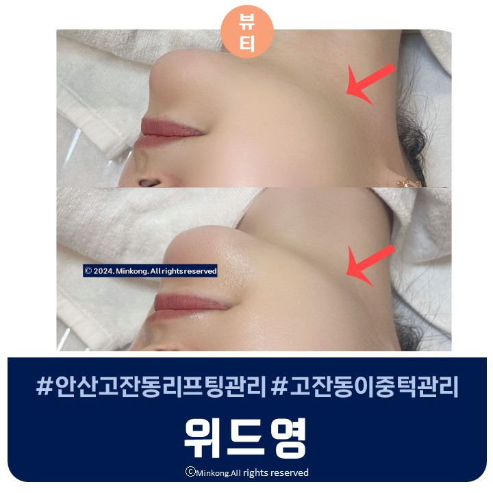  안산 고잔동 리프팅관리 위드영 피부노화 전에 미리 관리받자