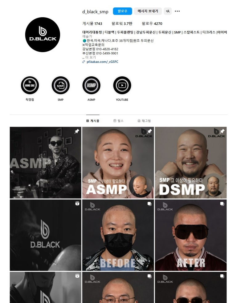  다이어트 부작용으로 인한 탈모 해결 방법 두피 문신 강추