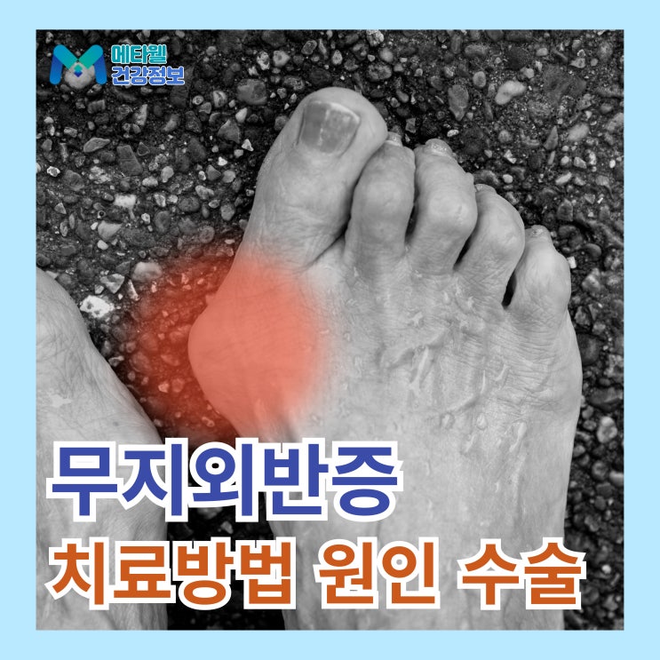  엄지발가락 통증 발가락이 휘는 현상 무지외반증 원인 구두때문? 치료방법