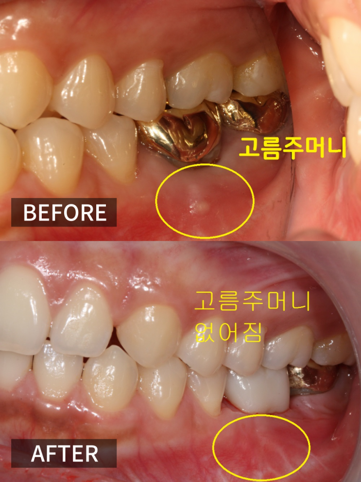  잇몸 고름주머니 터짐, 약으로안되요. 재신경치료후기,비용