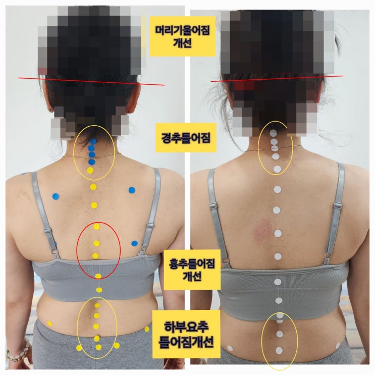  [부산 동래 사직동 좌골신경통 치료] 저희 센터에서 고관절·허리 통증을 개선하신 회원님 사례 소개