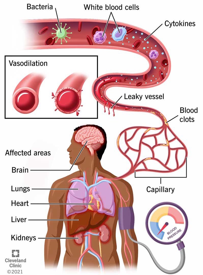 Septic Shock septic-shock