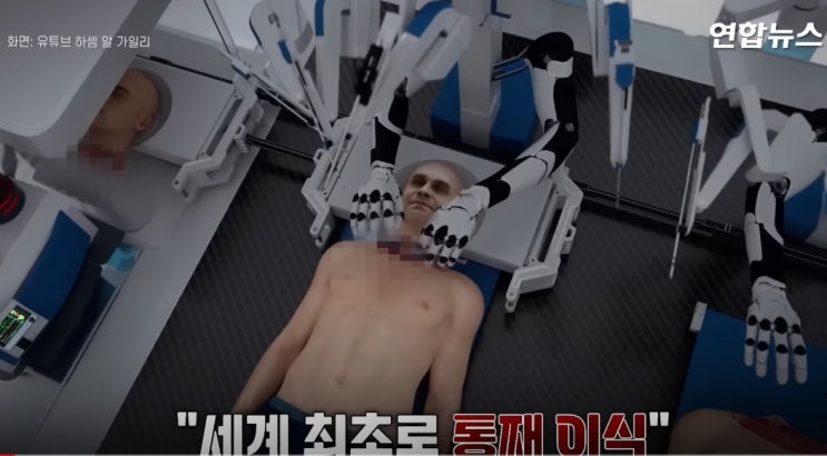  머리 이식에 대한 소식과 지식의 응용