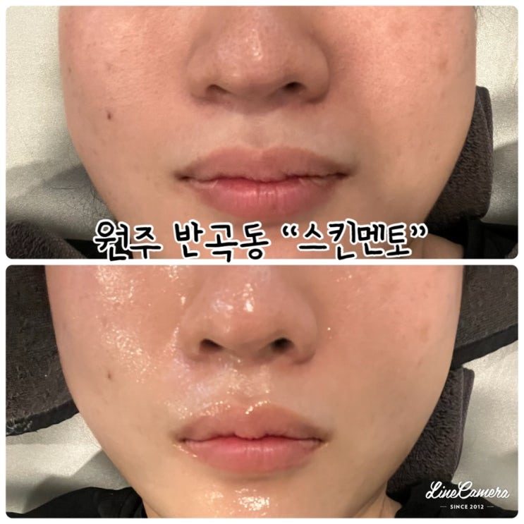  "스킨멘토" 원주피부관리샵으로 모공 탄력 문제성피부관리 받은후기