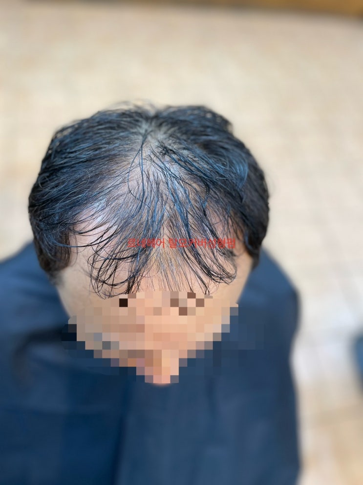  남자탈모 리얼변신 부산사상르네시떼6층 탈모헤어클리닉전문미용실 부산에서전국으로 전국에서부산으로.