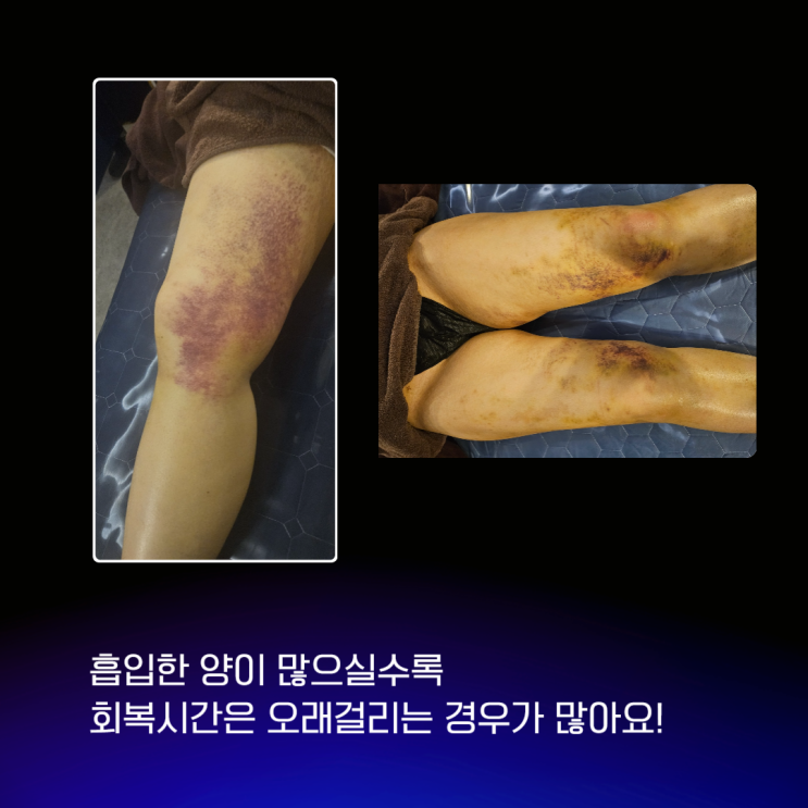  바이오본드 에 대해 자주 문의주시는 질문 대표원장이 직접 정리해 봤습니다.