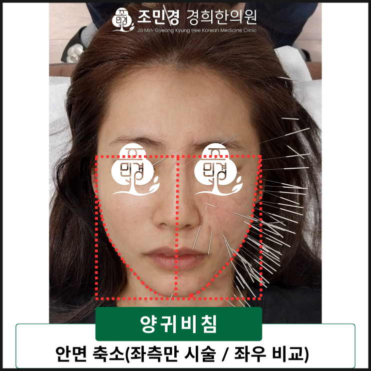  [치료 사례] 동안을 만들어주는 한방미용성형: 황진이침, 양귀비침(하남 감일 감이동 조민경 경희한의원)